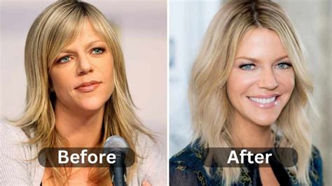 Kaitlin Olsons Plastic Surgery